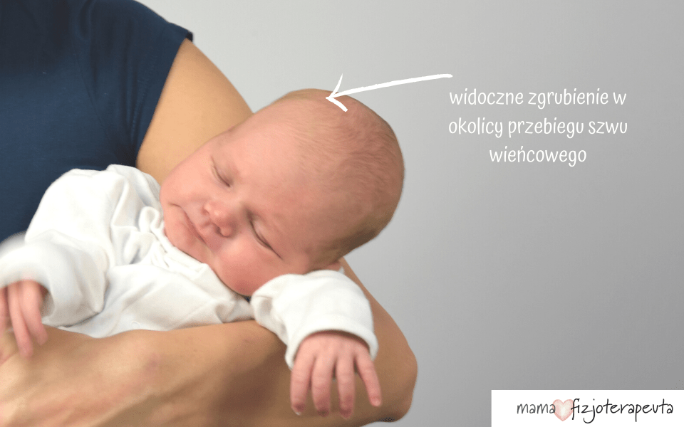 widoczne zgrubienie w okolicy szwu wieńcowego